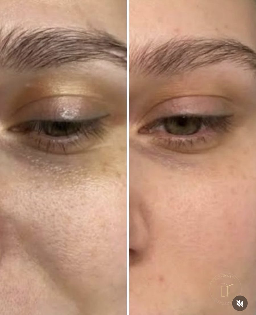Antes e depois de tratamento de cicatriz de acne