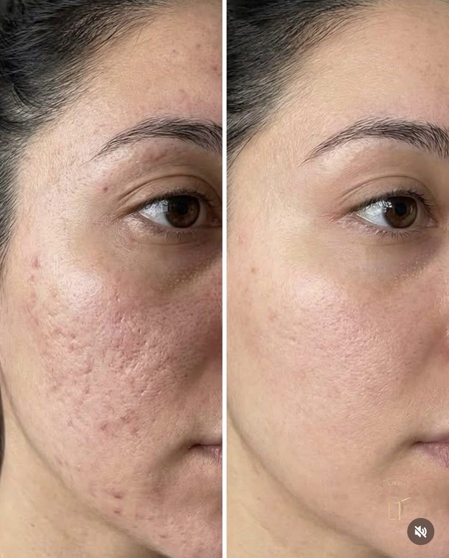 Antes e depois de tratamento de cicatriz de acne, perfil