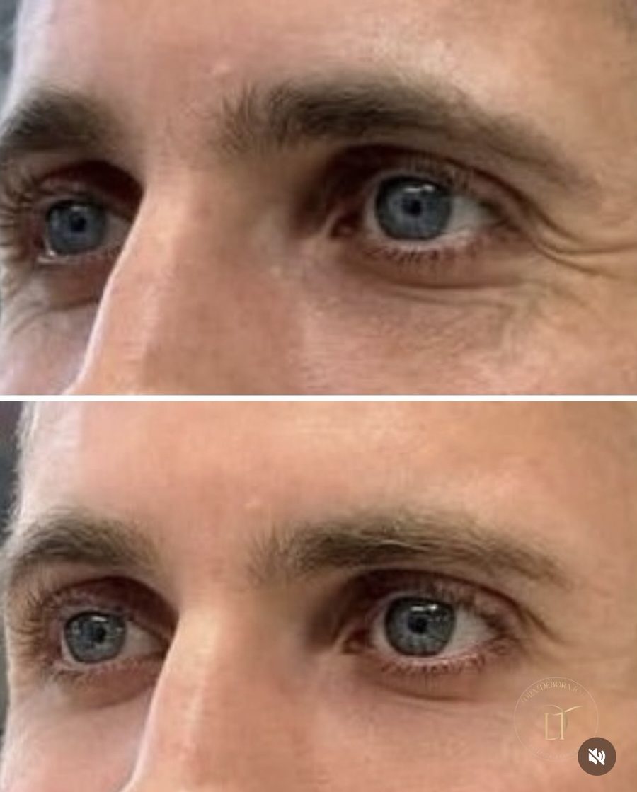 Antes e depois de tratamento de cicatriz na testa
