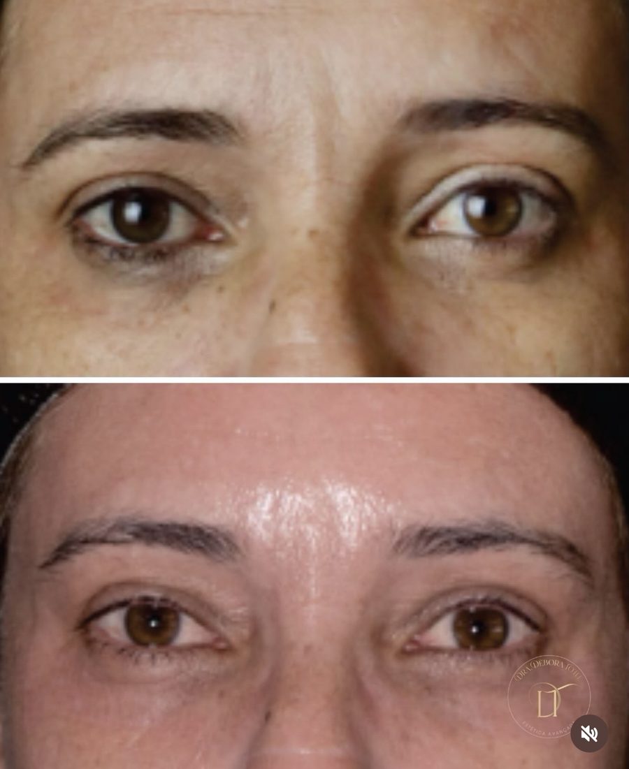 Antes e depois de tratamento da área dos olhos