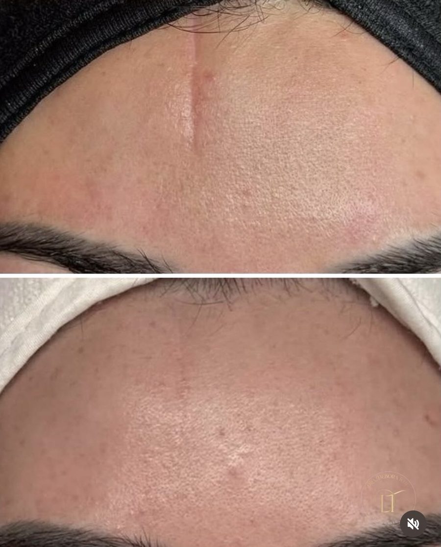 Antes e depois de tratamento da área dos olhos