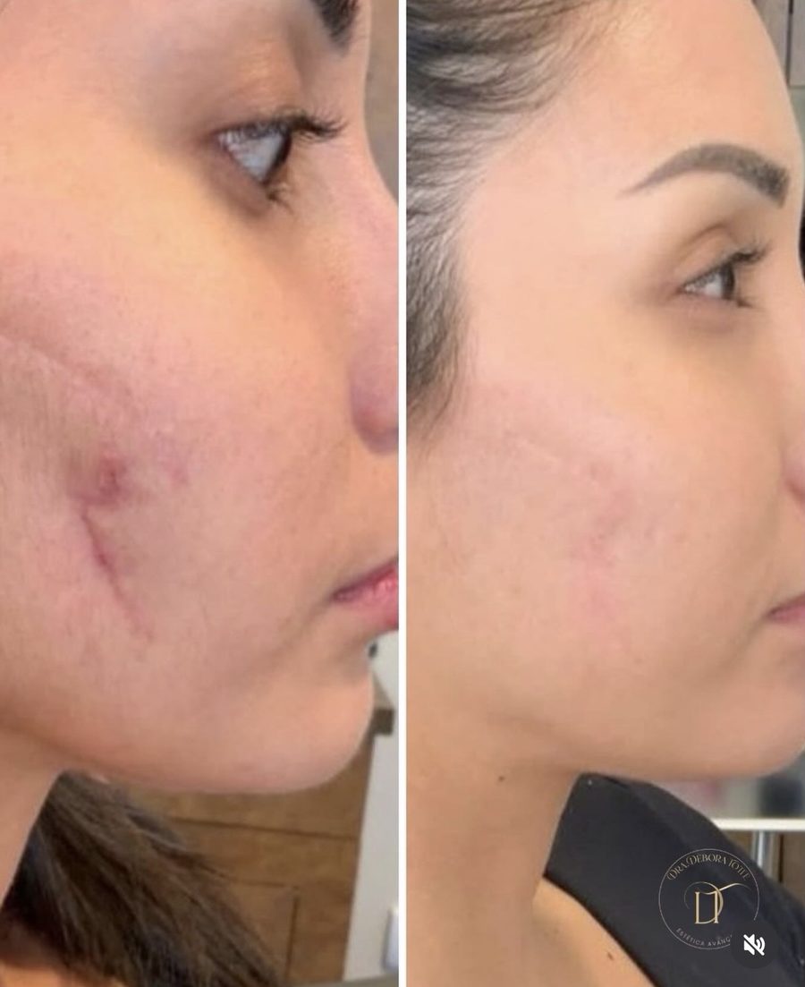 Antes e depois de tratamento de cicatriz de acne