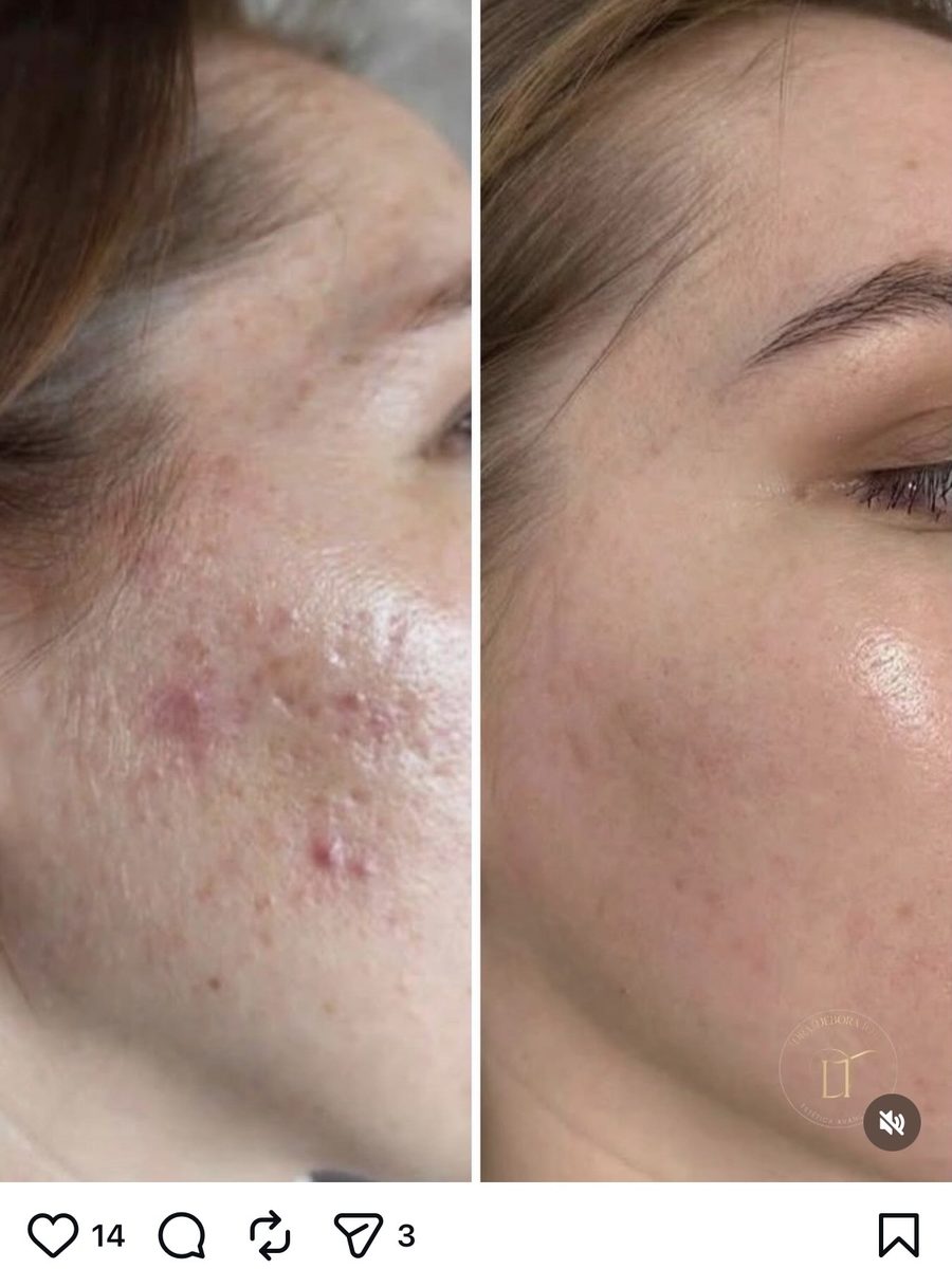 Antes e depois de tratamento da área dos olhos